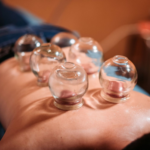 cupping therapy ventouses